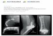 Comprehensive Periprosthetic Fracture Management of … · Comprehensive Periprosthetic Fracture Management of the Hip and Knee ... 16:50–17:00 Fixation options and biomechanical
