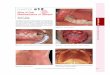 Manifestations of Disease - mhprofessionalresources.com · 12-5 CHAPTER e12 Atlas of Oral Manifestations of Disease Figure e12-22 Severe periodontal disease, missing tooth, very mobile