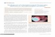 Misdiagnosis of a Nasopharyngeal Pleomorphic Adenoma …medcraveonline.com/JOENTR/JOENTR-01-00006.pdf · Misdiagnosis of a Nasopharyngeal Pleomorphic Adenoma as a Nasopharyngeal Carcinoma