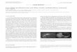 Liver failure posthepatectomy and biliary fistula ...scielo.isciii.es/pdf/diges/v108n5/nota3.pdf · because biochemical values and good performance status ... bile measurement. Furthermore,