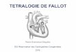Tétralogie de Fallot - arcothova.com · ETIOLOGIES Syndrome de Di GEORGE Syndrome d’alcoolisme fœtal (SAF) Syndrome de GOLDENHAR (microsomie hémifaciale) Syndrome Cardio-facial