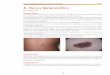 8. Nevus Melanocítico - cursostemis.comcursostemis.com/LPN6801/book_image/LPN6801_modulo2_2.pdf · 40 Curso on line diagnóstico diferencial de dermatosis en Piel Negra Módulo 2
