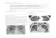 CASO CLÍNICO ARP Nº 6: PNEUMONIA POR PNEUMOCYSTIS ... 107  · PDF filea pneumonia bilateral, praticamente todos por Pneumocystis jirovecii (apenas um caso por infeção por citomegalovirus)2