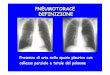 IL PNEUMOTORACE[1] [modalità compatibilità]fisiokinesiterapia-news.it/download/pneumotor.pdf · PNEUMOTORACE SPONTANEO CARATTERISTICHE • Calibro adeguato del catetere e del tubo