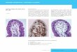 SEZIONE SCIENTIFICA - Patologia in pillolem4.ti.ch/fileadmin/DSS/DSP/ICP/pdf/patologia_in_pillole/2014/... · del duodeno non mostra alterazioni di rilievo. Le biopsie duodenali evidenzia-