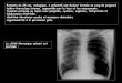 Patiente de 24 ans, tabagique, a présenté une douleur ...onclepaul.net/wp-content/uploads/2011/07/ECN-276-pneumothoraxFILE... · Etiologies du pneumothorax PNO secondaires spontanés