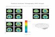 Positron Emission Tomography (PET) Images · PDF filePositron Emission Tomography (PET) Images ... The Brain: Understanding Neurobiology Through the Study of Addiction: Complete Lessons