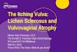The Itching Vulva: Lichen Sclerosus and Vulvovaginal Atrophy · LP and LS •Elastic stain – marked decrease in papillary dermal elastic fibers in LS c/w LP Fung M, LeBoit PE. Light