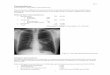 2017 yliopilastele Pneumothorax INGL K - Kliinikum · 2017 3 Spontaneous pneumothorax Spontaneous pneumothorax (SP) develops in people without an inciting event like coughing, trauma
