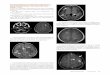ON-LINE APPENDIX: PICTOGRAPHIC AND TEXTUAL ATLAS OF … · ON-LINE APPENDIX: PICTOGRAPHIC AND TEXTUAL ATLAS OF MRI SCORING TOOL (ADAPTED FROM VERHEY ET AL1) All parts are reproduced