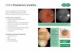 UVEA Posterior Uveitis - Specsavers Green club · UVEAPosterior Uveitis Uveitis is a general term describing a group of inflammatory diseases that produce swelling and destroy eye