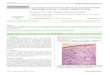 A RARE, UNIQUE TUMOR - Dermatology Online JournalAdamantinoid trichoblastoma is a rare adnexal tumor which clinically masquerades as various benign and malignant lesions. Less than