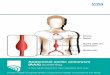 Abdominal aortic aneurysm (AAA) screening...their local service to arrange a test. What is an abdominal aortic aneurysm? The aorta is the main blood vessel that supplies blood to your