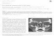 Extraskeletal osteosarcoma of the orbitdownloads.hindawi.com/journals/sarcoma/1998/530235.pdf · 2019-08-01 · Extraskeletal osteosarcoma of the orbit, showing neoplastic osteoid