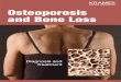 Osteoporosis and Bone Loss (PDF)menopause? The majority of people with osteoporosis are women. Those past menopause are more at risk. • Did your mother or father have bone loss or