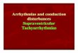 Arrhythmias and conduction disturbances Supraventricular ...Mobitz type I block Caused by conduction delay in the AV node in 72% of patients and by conduction delay in the His -Purkinje