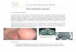 Curso de Poliposis Nasal - SEORL · 2015-09-11 · Curso de Poliposis Nasal PN, a los que se les realizaron diversas investigaciones alérgicas, Bunnang y cols (15) encuentran que