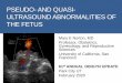 PSEUDO-AND QUASI- ULTRASOUND ABNORMALITIES OF THE … · Creating anxiety related to false-positive diagnoses ... UPJ obstruction 5%. Vesicoureteral reflux 5-10%. Posterior urethral