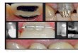 Multidisciplinary Enhancement of - AACDaacd.com/proxy/files/Students and Faculty/Rubinstein_Salama.pdfWhen implant therapy is the ... and soft tissue deficiencies within the esthetic