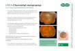 UVEA Choroidal melanoma - Green Club · 2019-09-20 · UVEAChoroidal melanoma Referral: Urgent to normal depending on characteristics* The annual malignant transformation rate of