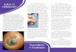 What is P Melanoma? - Fight Eye Cancer › ... › uploads › 2016 › 02 › melanomabrochur… · Choroidal Melanoma basic inFoRmation & tReatment Plans Ocular Oncology Service