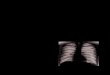 기흉, 기종격증, 심막기종: 임상화보 - KoreaMed...Pneumothorax in a 46-year-old man with multiple large bullae. Chest CT scan through upper thorax show multiple large bullae