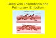 Deep vein Thrombosis and Pulmonary Embolism · One example is an inherited condition that causes the blood to clot more easily than normal (factor V leiden). • The contraceptive