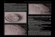 TCTAP C-025 Management of Coronary Perforation and ... · ography showed coronary perforation was sealed after prolonged balloon inﬂation. Case Summary. Prolonged balloon inﬂation