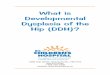 What is Develoopmental Dysplasia of the Hip (DDH)? · PDF file 2015-04-28 · 1 What is Developmental Dysplasia of the hip (DDH)? Developmental dysplasia of the hip means that your
