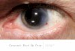 Cataract Post Op Care - ncascade.com...Post Op Day #1 • Anterior chamber • Cell usually around 2+ (suspect TASS if 3+ or greater) • Flare - usually not much • Endophthalmitis