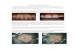 Adhesive Restoration › ... › 05 › Adhesive-Restoration.pdf · 2017-05-04 · ADHESIVE RESTORATION An adhesive restoration is a tooth coloured filling material that is bonded