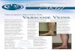 Treatment O p tions for Varicose Veins...Treatment O p tions for Varicose veins can range from small, thin, red spider veins that lie just underneath the skin surface or they can be