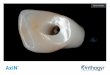 Revue Clinique - Anthogyr · 2019-12-11 · 1 & 2. Parodontite chronique d’intensité moyenne, avec perte d’attache sans profondeur de sondage, biotype parodontal moyen, perte