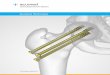 Cannulated Screw System - Acumed Acued¢® Cannulated Screw Syste Surgical Technique 4 Instrumentation