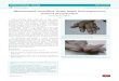 Rheumatoid vasculitis: same hand, heterogeneous clinical … · 2020-07-23 · anti-CCP antibodies. The treatment included methotrexate, prednisolone and hydroxicloroquine. Despite