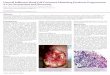 Unusual Infiltrative Basal Cell Carcinoma Mimicking ... · presentation of BCC resembling PG. BCC can present atypically, which can lead to false diagnoses. Despite the clinical presentation
