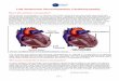Left Ventricular Noncompaction Cardiomyopathy · Left Ventricular Noncompaction Cardiomyopathy It is not known how common left ventricular noncompaction is, although it is suspected