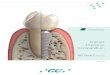 Implant Literature Compendium...Managing congenitally missing lateral incisors with implants The key factors to reach an excellent result By Dr. Miguel A Iglesia Puig, Spain 15 The