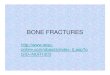 BONE FRACTURES - home.mca.k12.pa.ushome.mca.k12.pa.us/~farronatoa/bonefractures.pdf · FRACTURES • Closed – no penetration through skin a. Complete – bones broken into 2 or