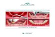 THE LOCATOR OVERDENTURE - · PDF file OVERDENTURE IMPLANTS. The LOCATOR Overdenture Implant System (LODI) is comprised of 2.4mm and 2.9mm narrow diameter dental implants (available