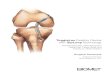 Fixation Device with ZipLoop Technology - Zimmer Biomet · 2020. 1. 13. · ToggleLoc Fixation Device with ZipLoop Technology Arthroscopic PCL Reconstruction Using Soft Tissue Graft