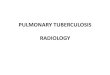PULMONARY TUBERCULOSIS RADIOLOGY · 2019. 3. 4. · PULMONARY TUBERCULOSIS RADIOLOGY. RADIOLOGICAL MODALITIES •Medical radiophotography •Radiography •Fluoroscopy •Linear (conventional)