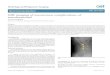 MR imaging of uncommon complications of transforaminal Transforaminal epidural steroid injection (TFESI)