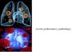 Acute pulmonary pathology. · 2020. 10. 17. · Fibrinous pleuritis in most cases is of infectious origin and is found in pneumonia, especially lobar, tuberculosis, infarction, lung