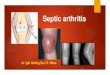 Septic arthritis · 2021. 6. 4. · Septic arthritis is a key consideration in adults presenting with acute monoarticular arthritis. Considered as medical emergency Failure to initiate