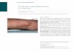Raised lesions on arms - dermatolarg.org.ar