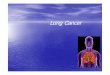 Lung Cancer presentation final - GMCH