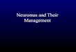 Neuromas and Their Management - Alpha Hand Surgery Centre