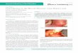 Oral Lipoma in the Buccal Mucosa: Case Report and 