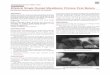 JCD CASE REPORT Bilateral Single Rooted Mandibular Primary 